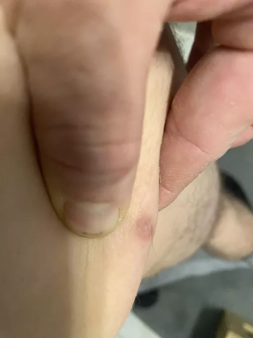 Should I lance it? It’s been there for years.