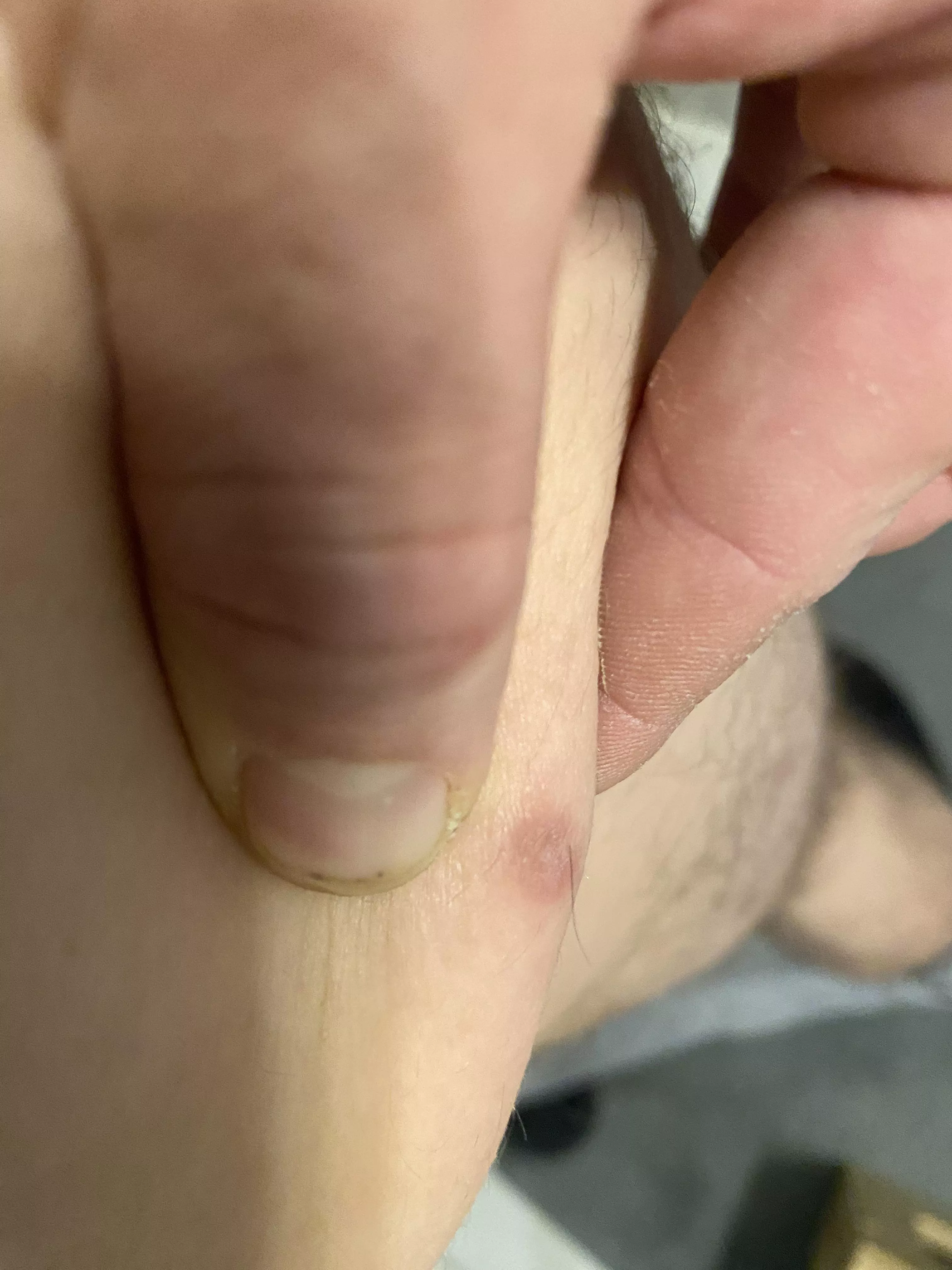 Should I lance it? It’s been there for years.