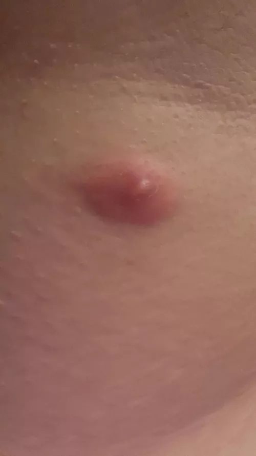 This insane cyst in my armpit is about to burst! I'll try my best to video it when it happens