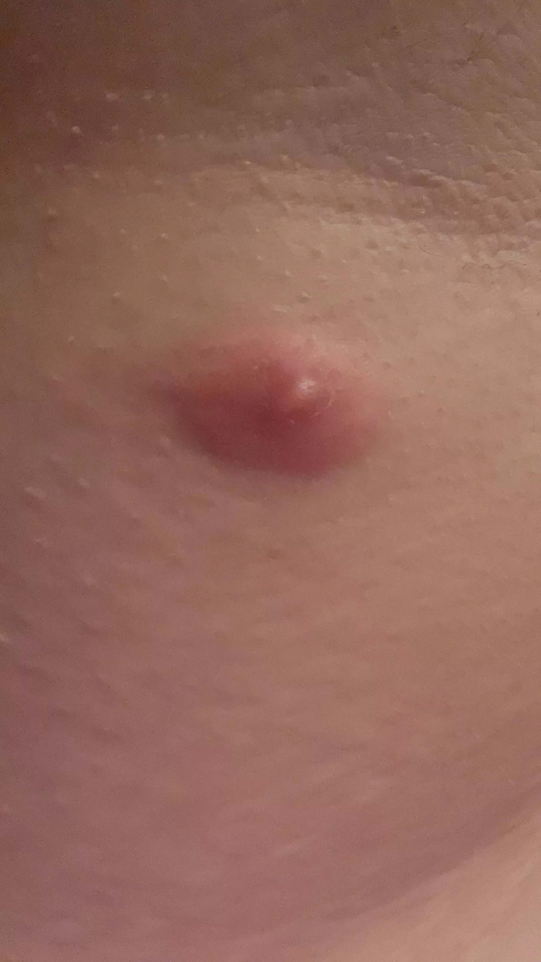 This insane cyst in my armpit is about to burst! I'll try my best to video it when it happens