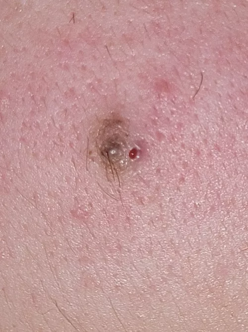 update on the popping of what I thought was my mole. my Primary care physician said I shouldn't be alarmed about it but it just seems to be an irritated or slightly infected ingrown hair.
