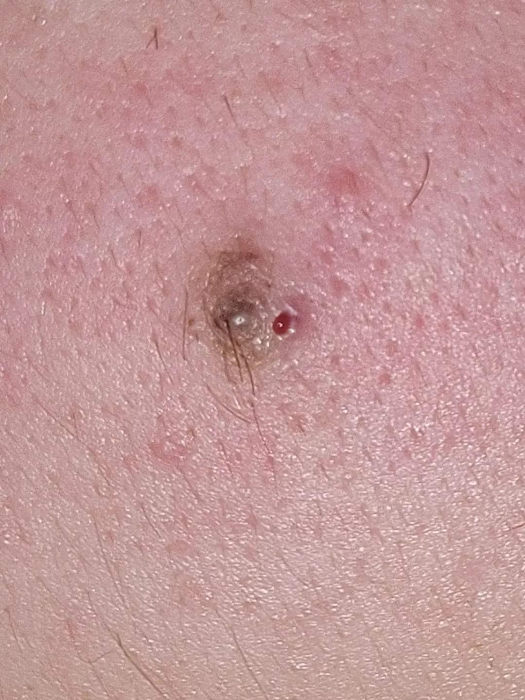 update on the popping of what I thought was my mole. my Primary care physician said I shouldn't be alarmed about it but it just seems to be an irritated or slightly infected ingrown hair.