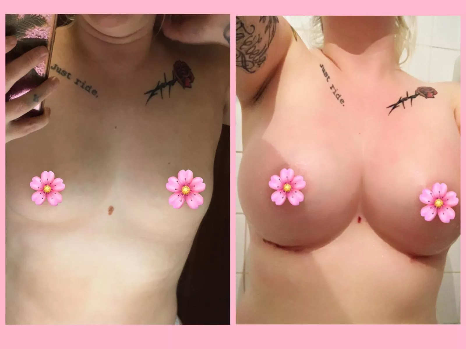 Before and 10 days post op 💕