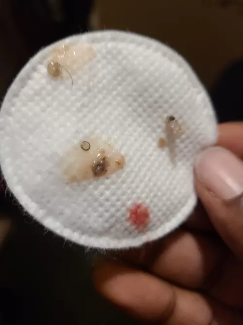 contents of a boil on my inner thigh that turned out to be an ingrown hair(as you can see it turned out to be a few hairs). it hurt so bad for DAYS. the super dark pieces were chunky and solid, I literally feel so much better