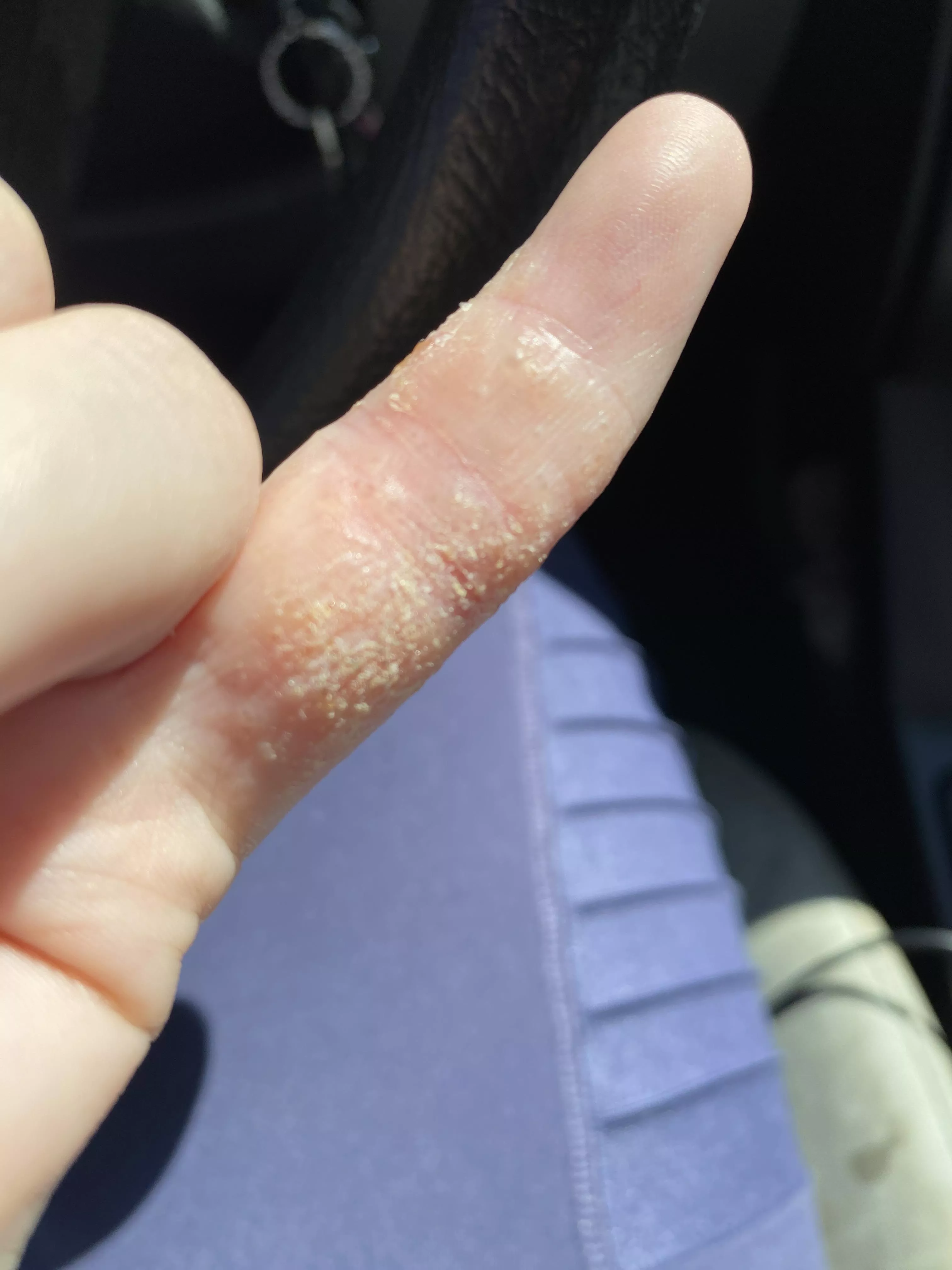 Forbidden pops curtsey of stress eczema