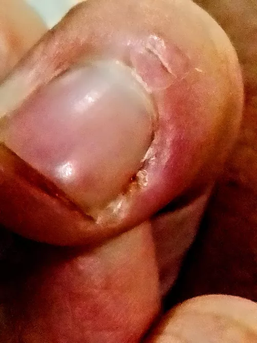 Pressed on my hangnail all day and the pain is just 👌🏻 (pic slightly edited to highlight the spot)