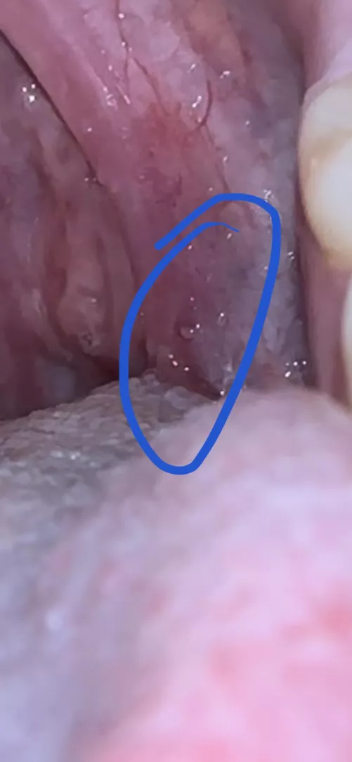 Small bump in back of mouth. Any ideas?