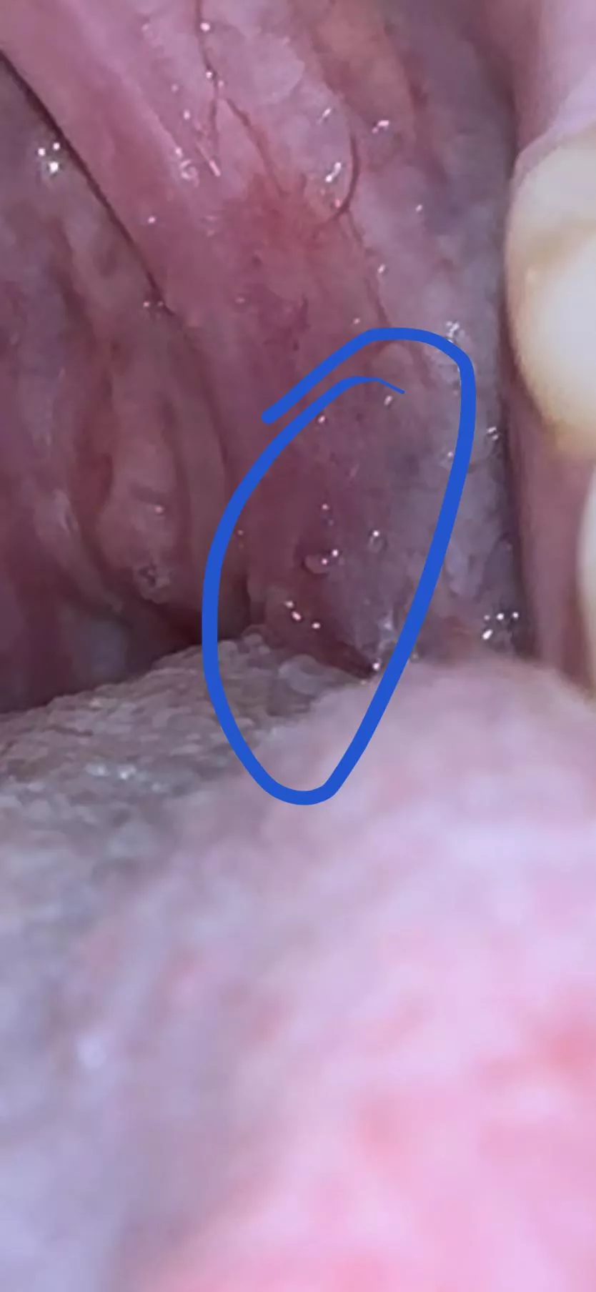 Small bump in back of mouth. Any ideas?
