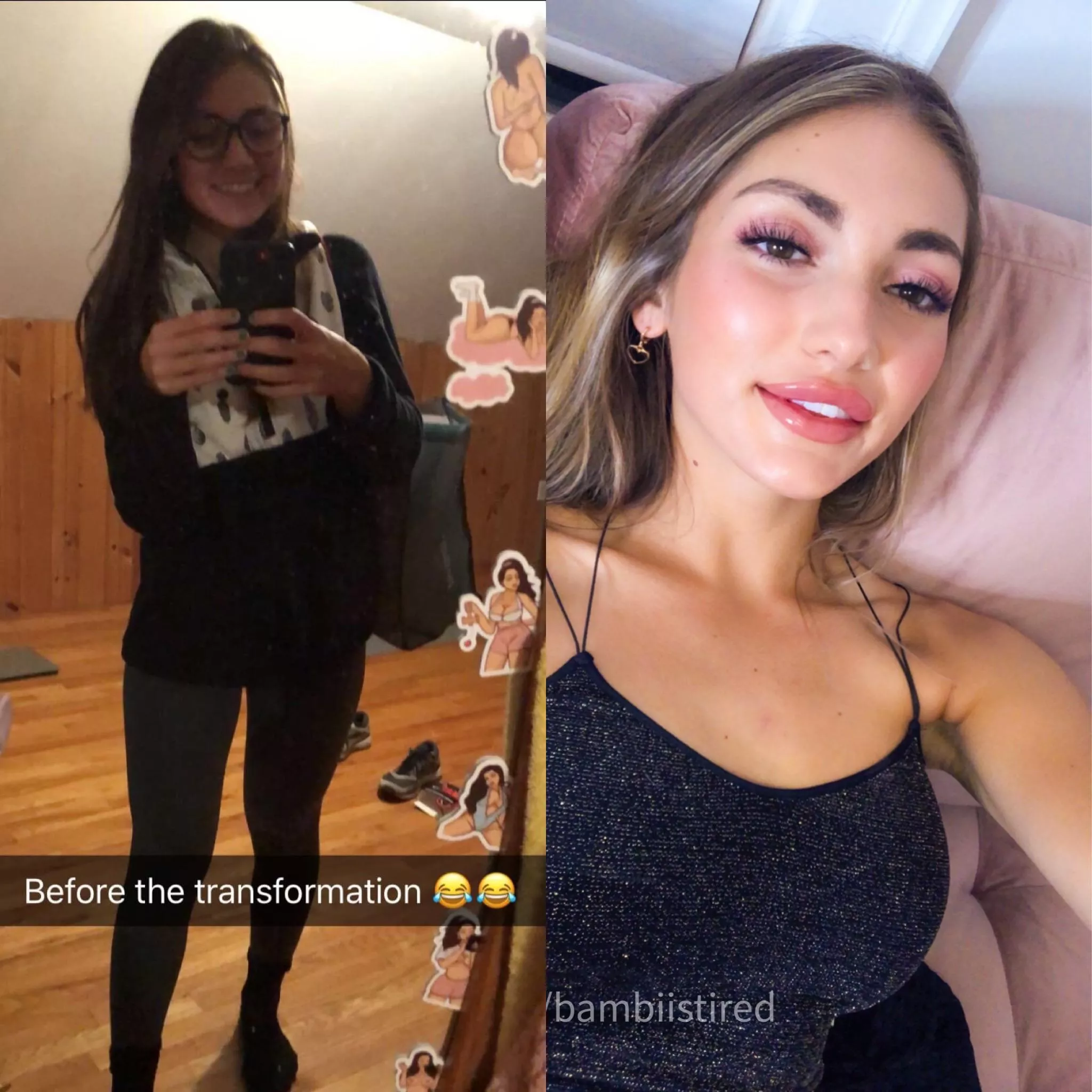 Literally minutes after my (f22) lip injections, they’ll be less swollen in a few days