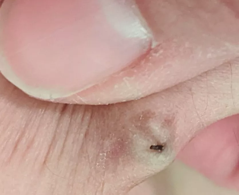 I was inserting old bellybutton piercing. As I was pushing it up from the bottom, this was coming out the top