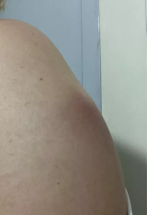 One week after receiving antitetanus vac. Do you think something will come out?