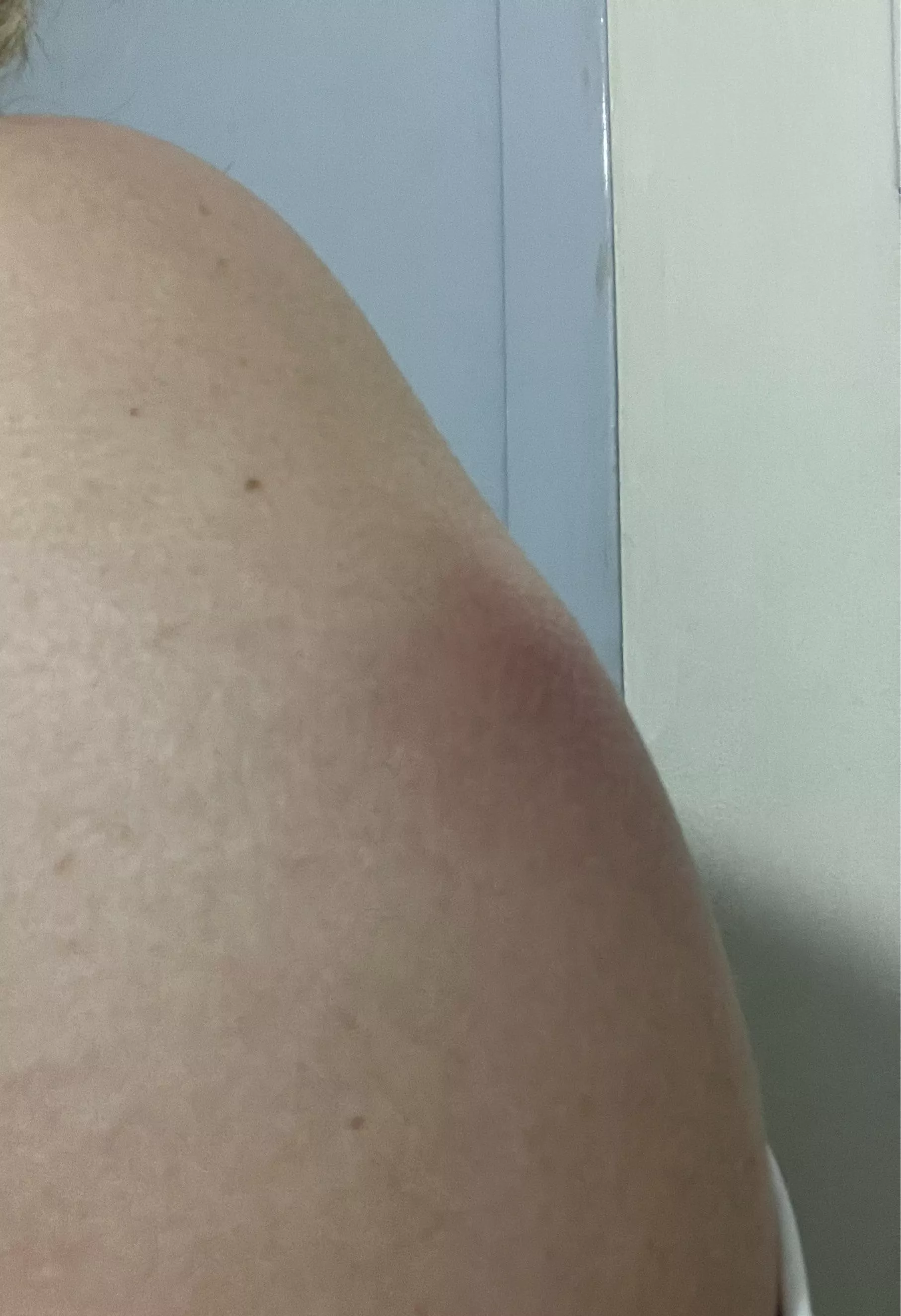 One week after receiving antitetanus vac. Do you think something will come out?