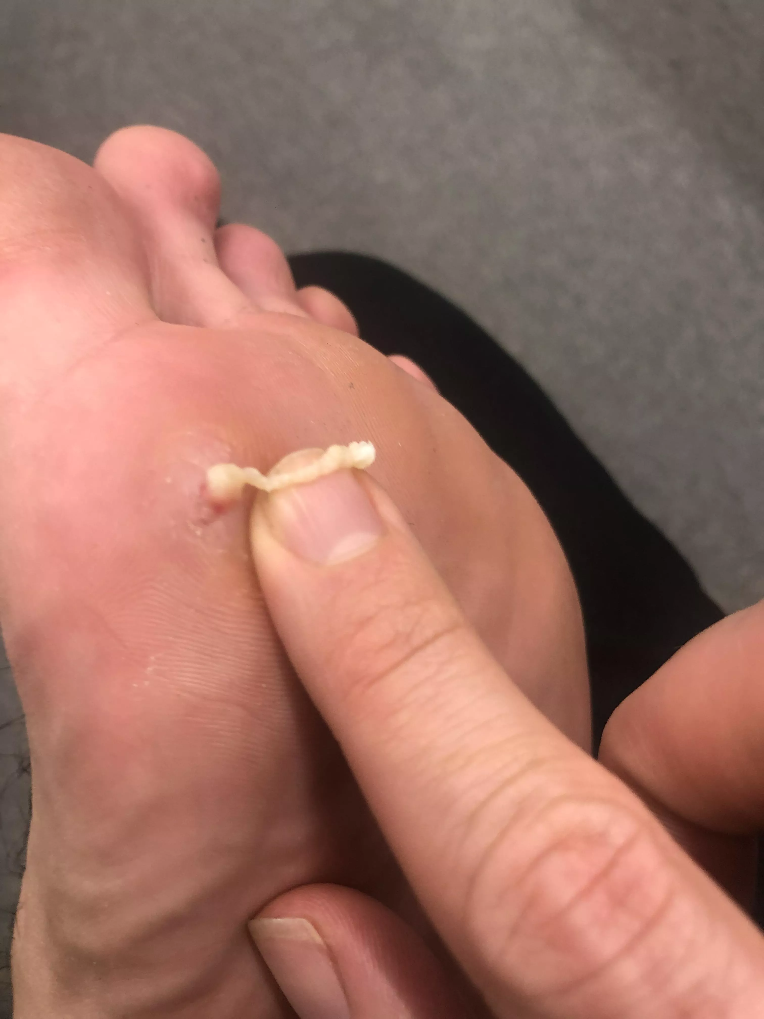 Was this a cyst on my foot?