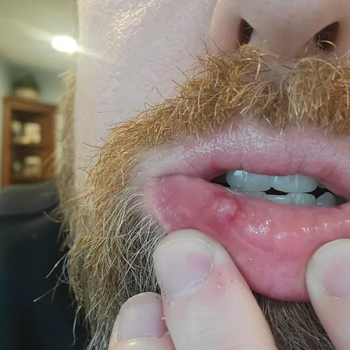 Consistent with mucocele?