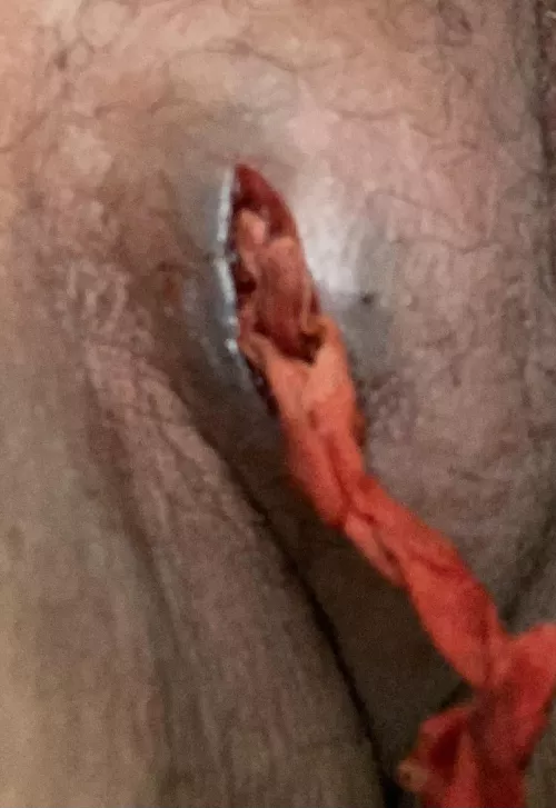 I post a month ago with a Bartholin cysts. It got drained that time but it came back Friday. This time this is what they did to drain it. They called it a Labia Abscess.