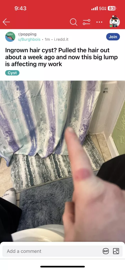 Ingrown hair cyst? Pulled the hair out a few days ago and now this lump is affecting my work