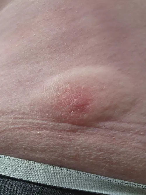 Well this popped up in under 6 hours. I've now got it circled with a time on it to make sure this doesn't get any bigger, but dang it is warm to the touch! This is right on my waist line, but I'll still mark NSFW for my boxers I guess