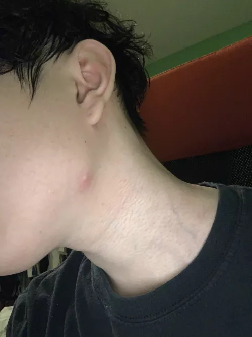 Help! Doctor said I could try popping this cyst. I couldn't pop it and now it's all red and sore.