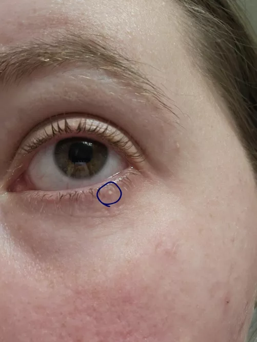 Was taking out contacts and noticed this Lil thing. Can't pop it cause the skin is too easy to maneuver. Will try to pop hopefully tmrw!