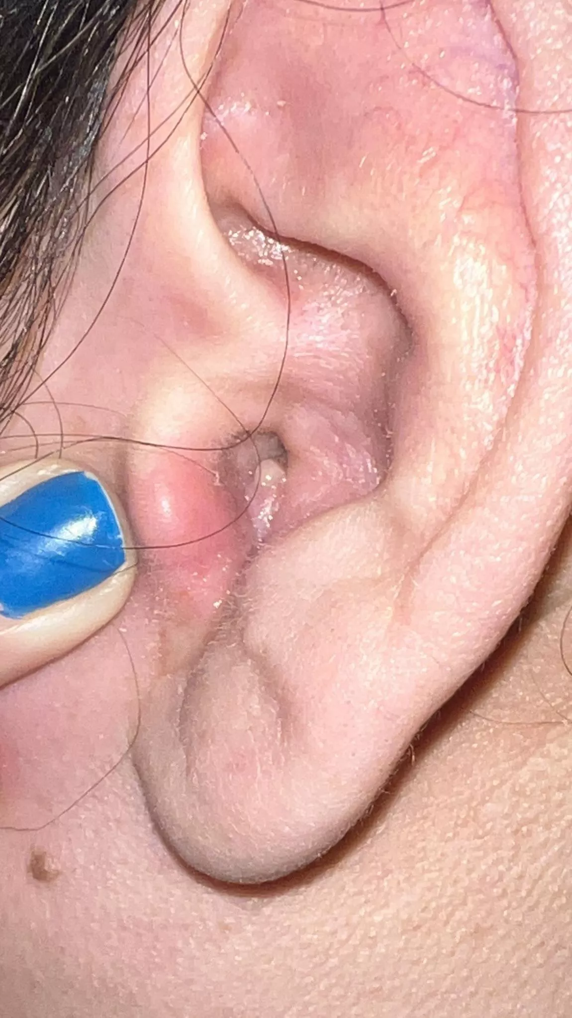 It’s so big I can’t hear! It came out of no where and it hurts so bad I can’t pop