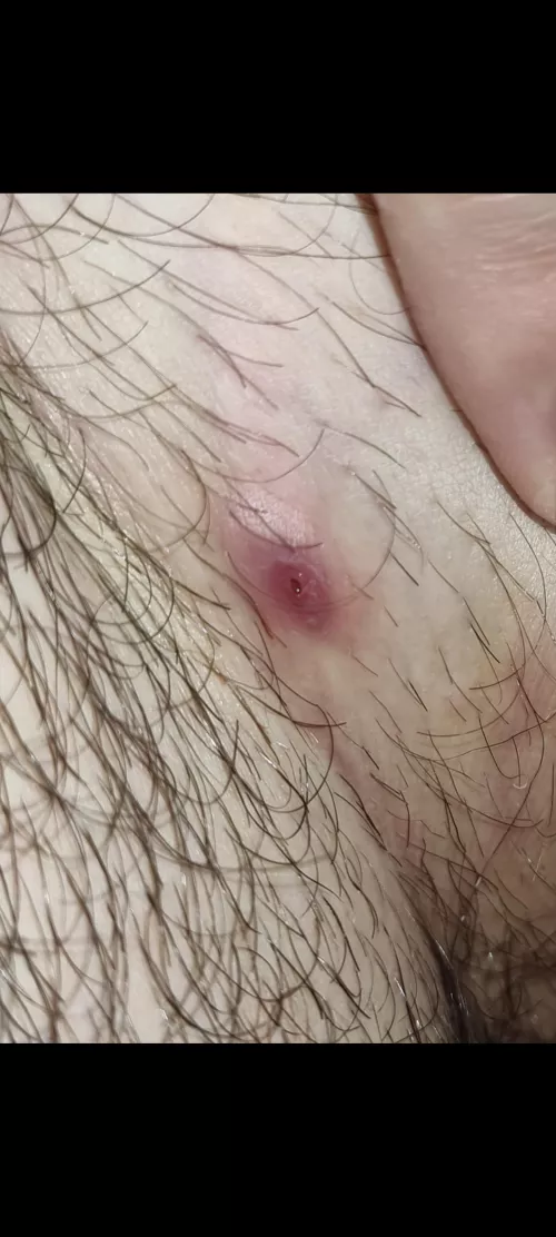 Stretch mark/pimple created from rubbing between my groin! Advice