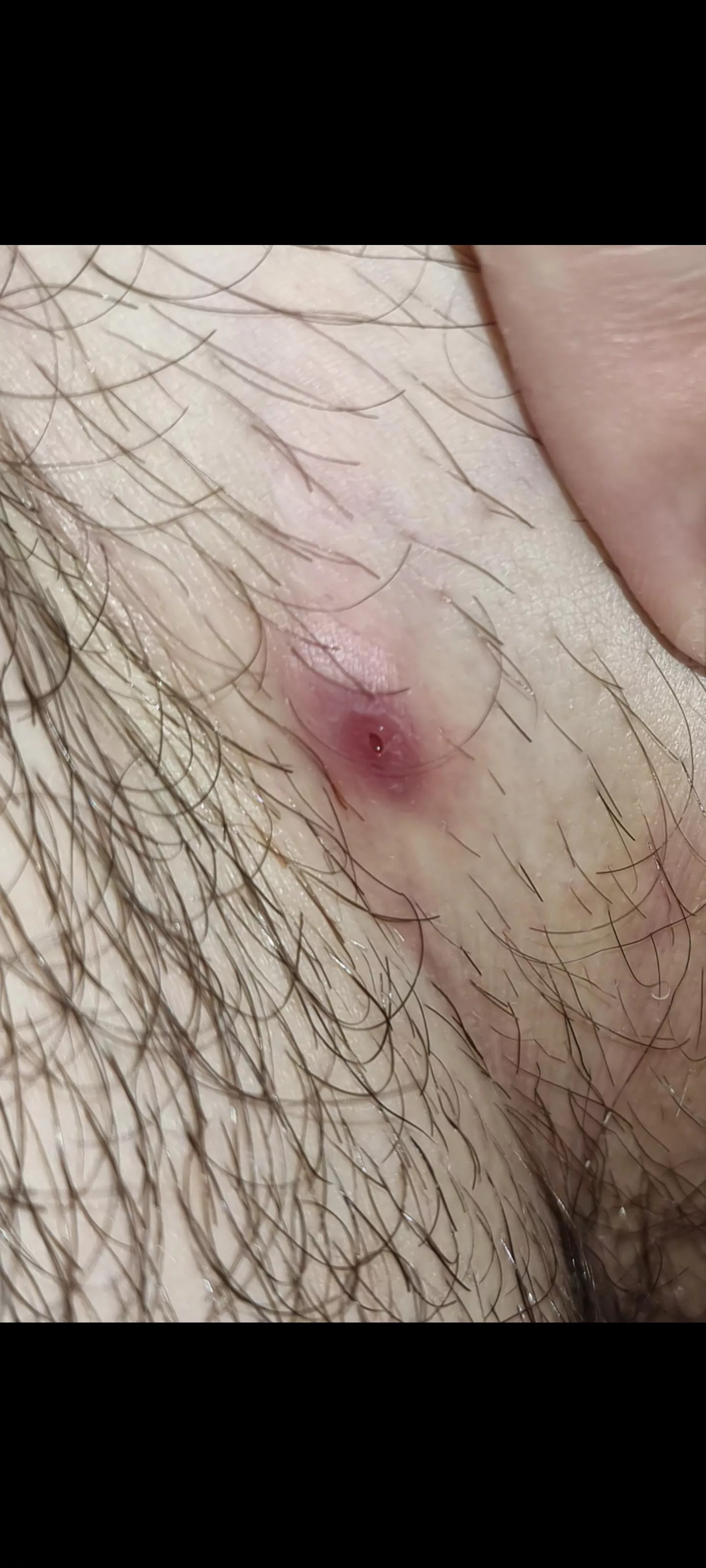 Stretch mark/pimple created from rubbing between my groin! Advice