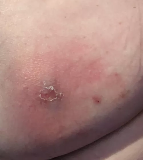 Dr tomorrow morning - area is rock hard & warm - doesn't seem right, about the size of a baseball