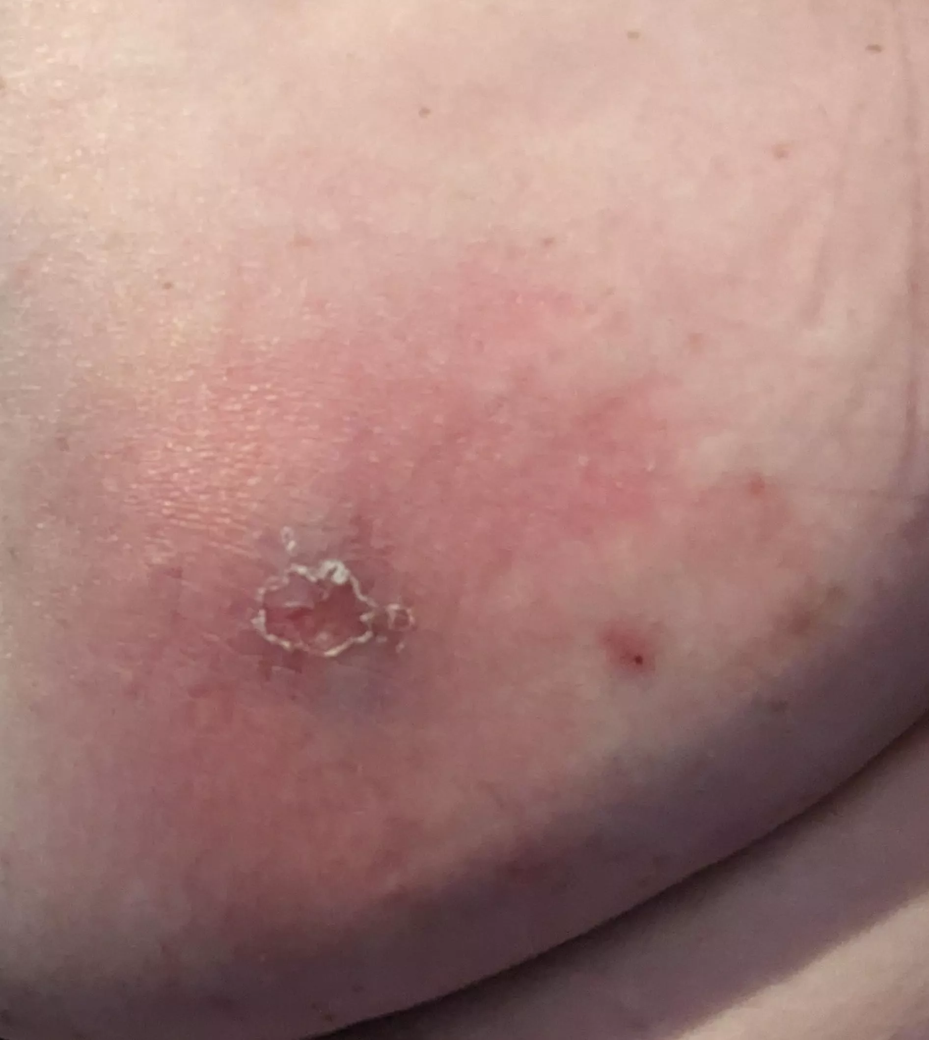 Dr tomorrow morning - area is rock hard & warm - doesn't seem right, about the size of a baseball