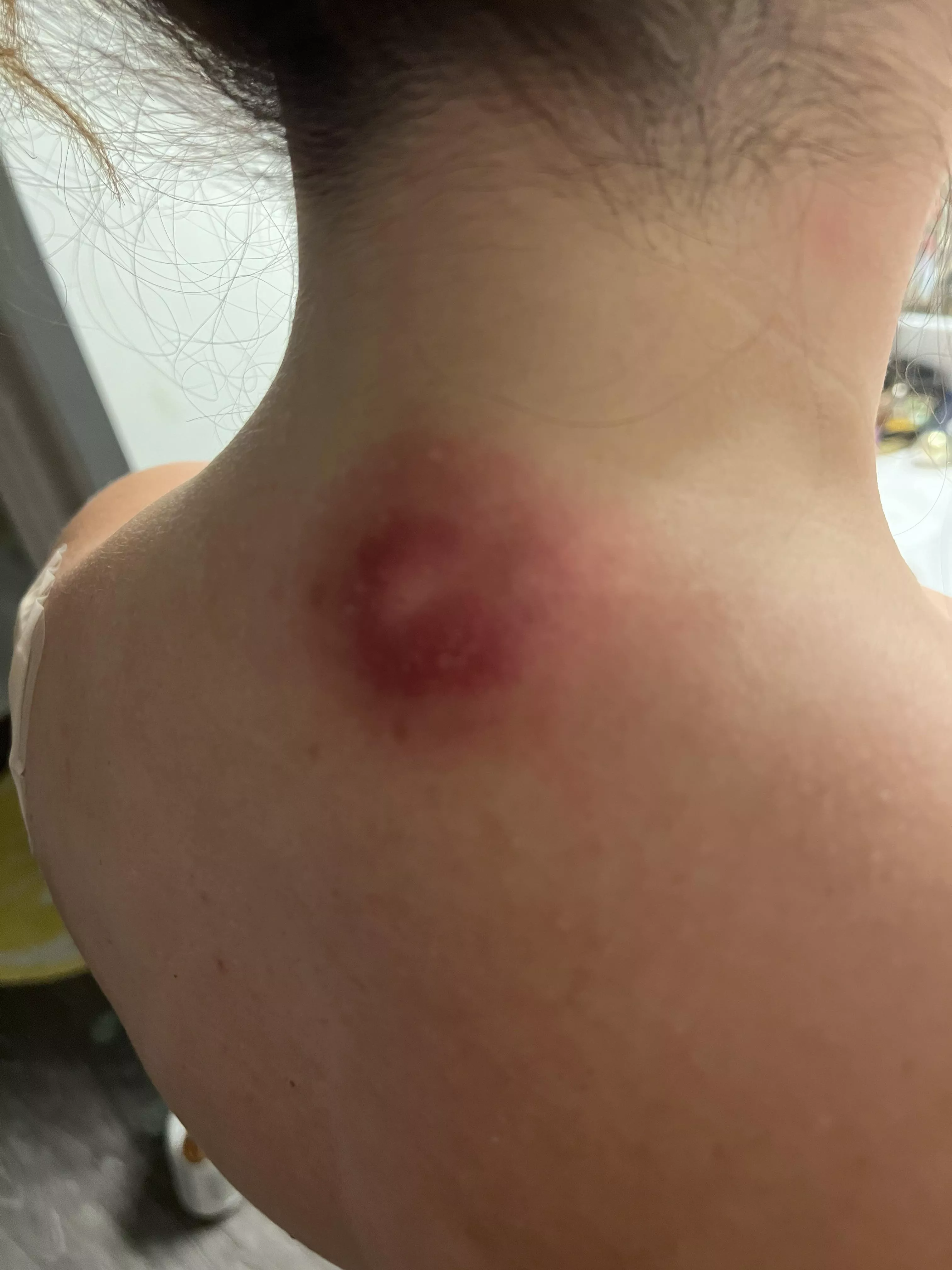 I have this cyst on the back of my neck and it is angry and keeps getting bigger.