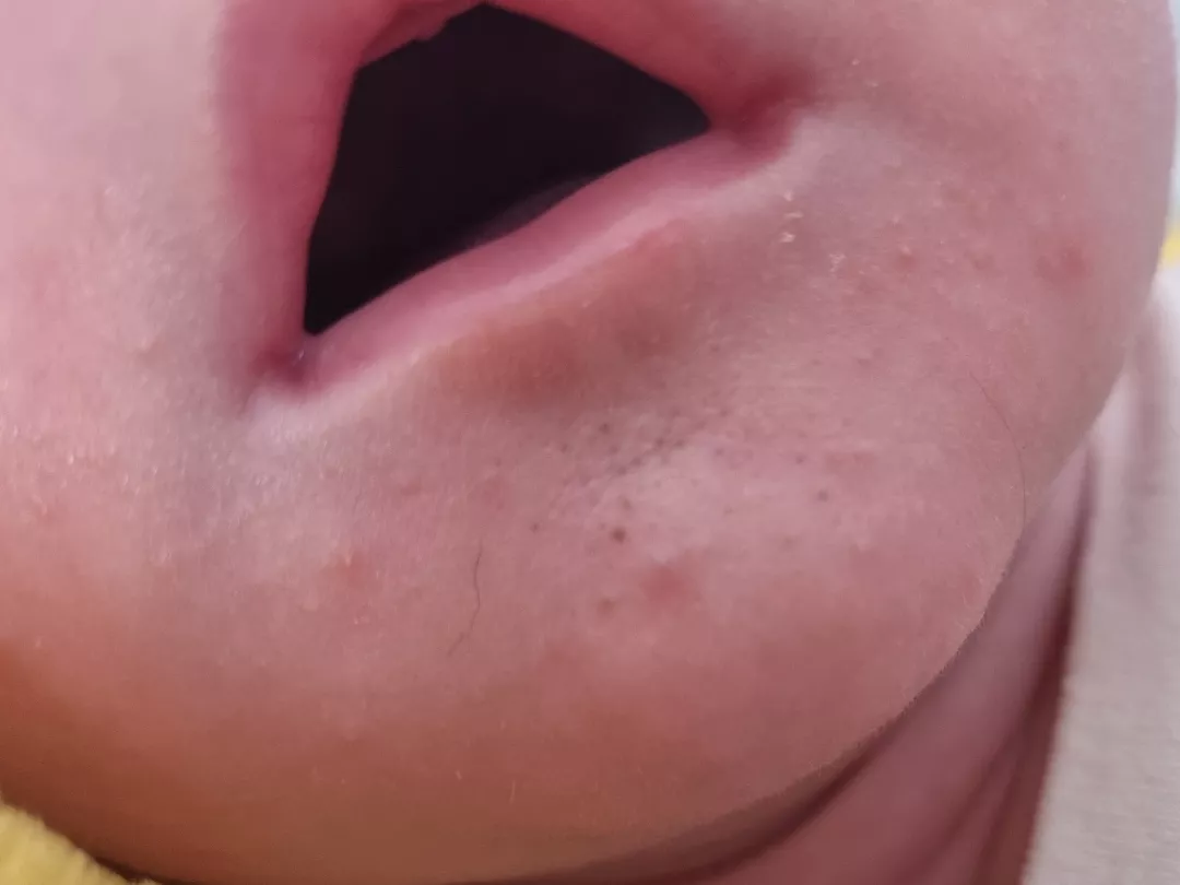 Forbidden pops on my 5 week old baby's chin