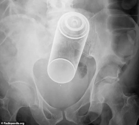 What’s the most risky thing you have inserted and had complications with ? Mine was a spray can lid that came off the can while inside me. PFA