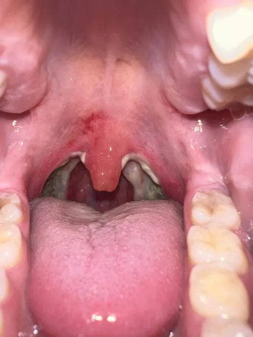 Tonsillectomy day 4 - it’s about to get worse lol