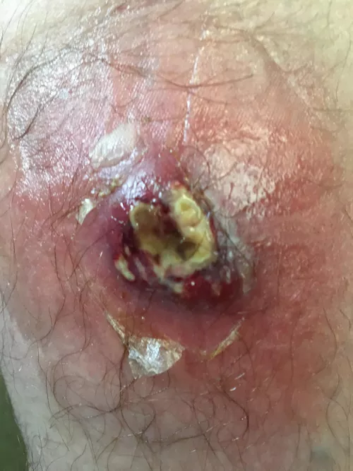 How many use inhalers and have skin problems ?