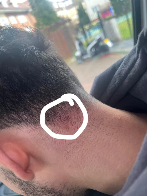 What is this on the back of head feels like a little lump tried popping it but nothing coming out & how do I get rid of it pls help !