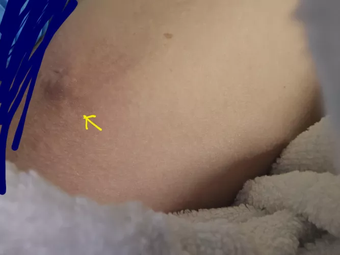 A pop coming soon. Right on my inner thigh. Probably the size of a quarter. Hurts bad hope to pop soon!