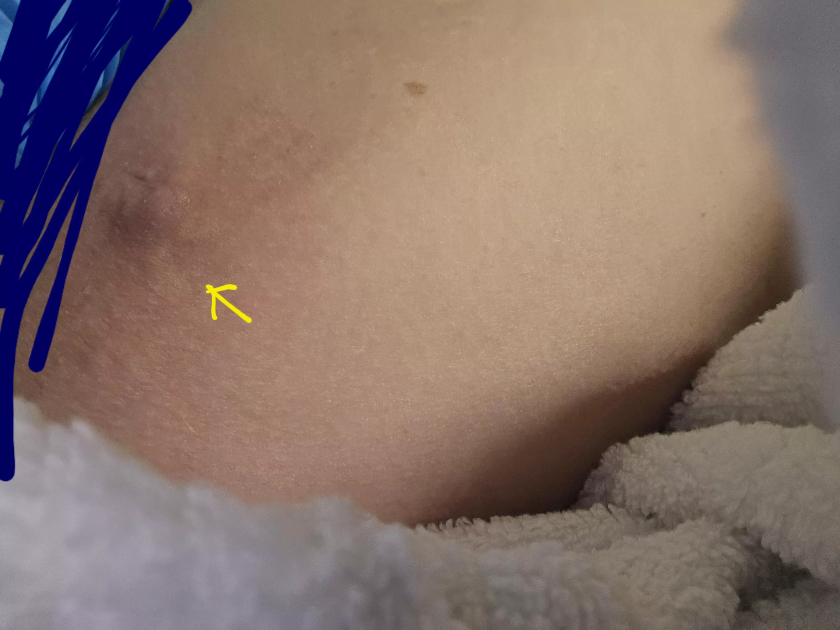 A pop coming soon. Right on my inner thigh. Probably the size of a quarter. Hurts bad hope to pop soon!