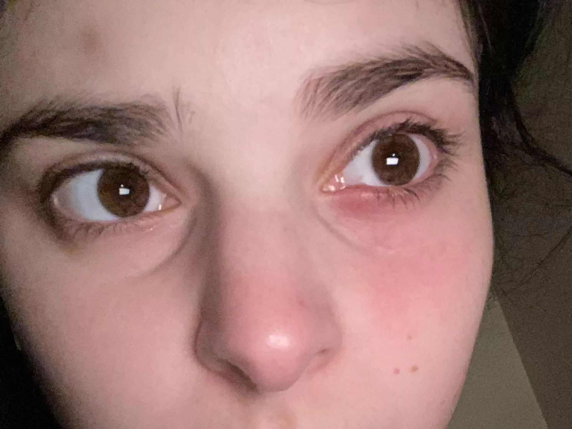 Some time and some hot compresses later. I am in hell