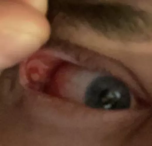 What is this? Its like a pimple inside my upper eyelid, now my eyes are alwyas full of white gunk