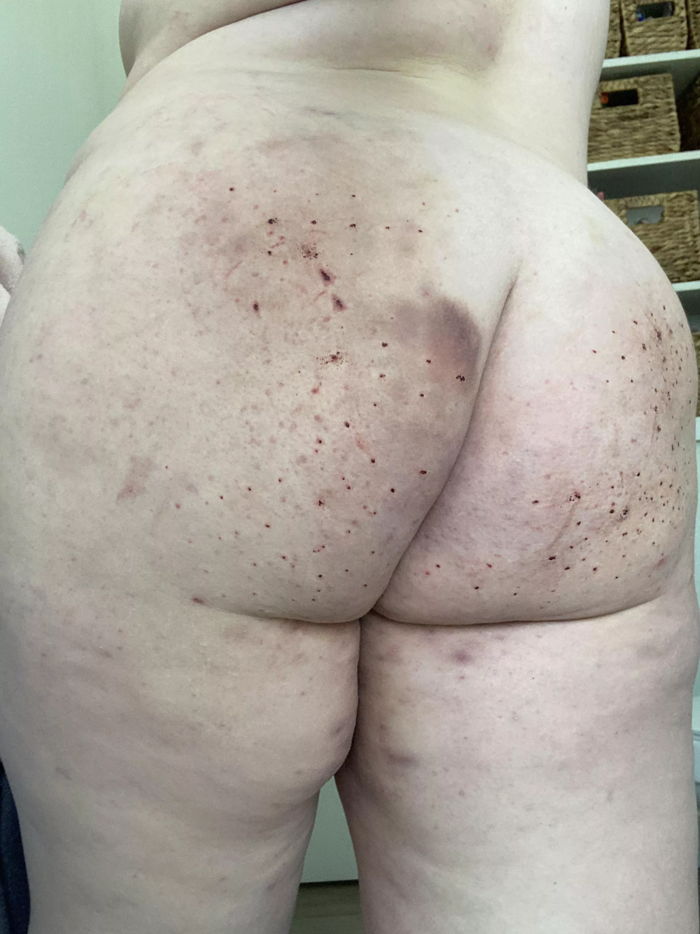 Bruises are my favorite🖤