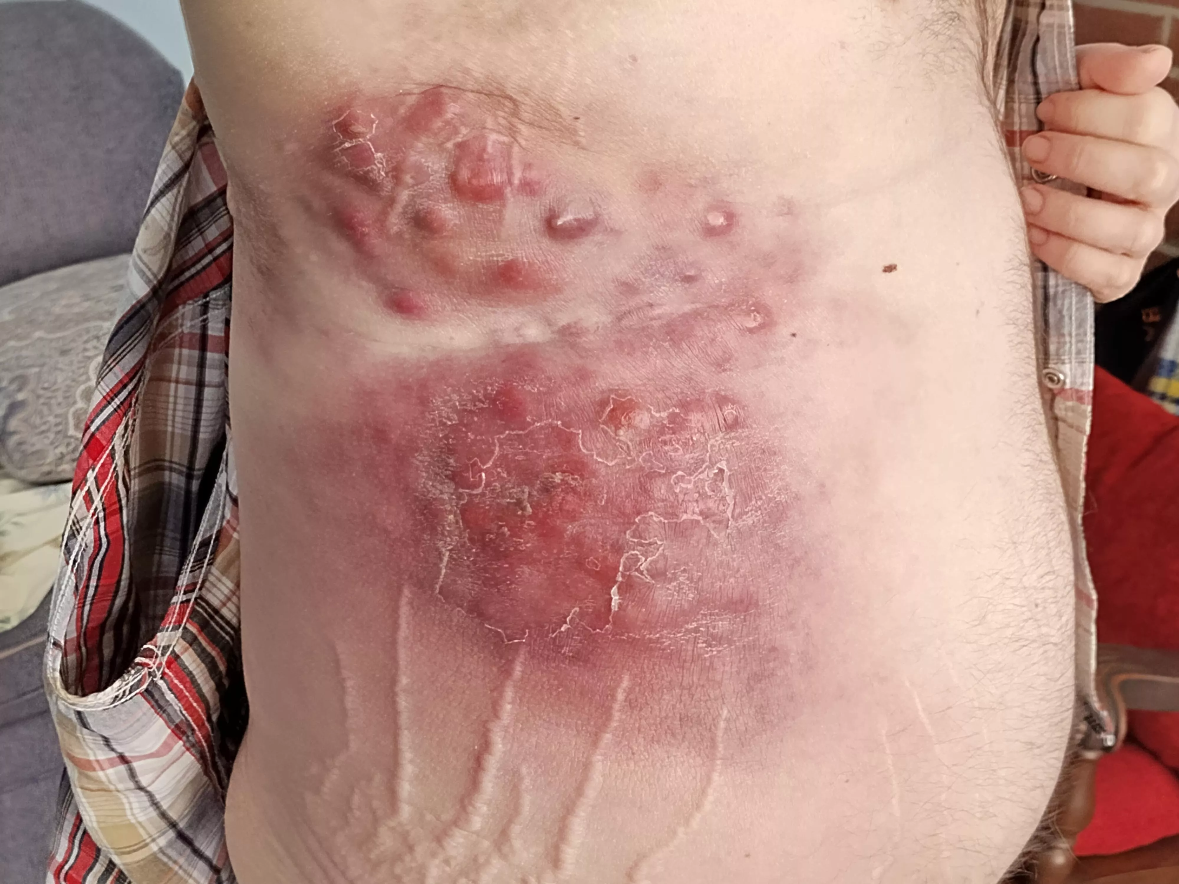 First time,. Forbidden pops, stage 4 skin cancer.