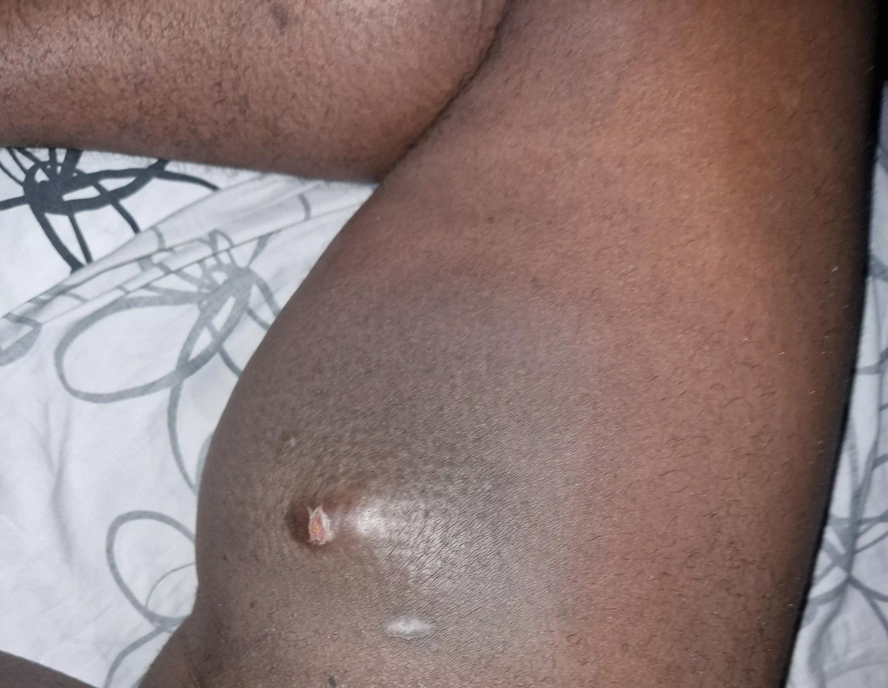 It's been 5 days and head still dry. Hope it gets better soon so I can upload a pop!