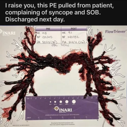 Look at this size of this lung clot! Imagine how much better you’d feel after it was out!