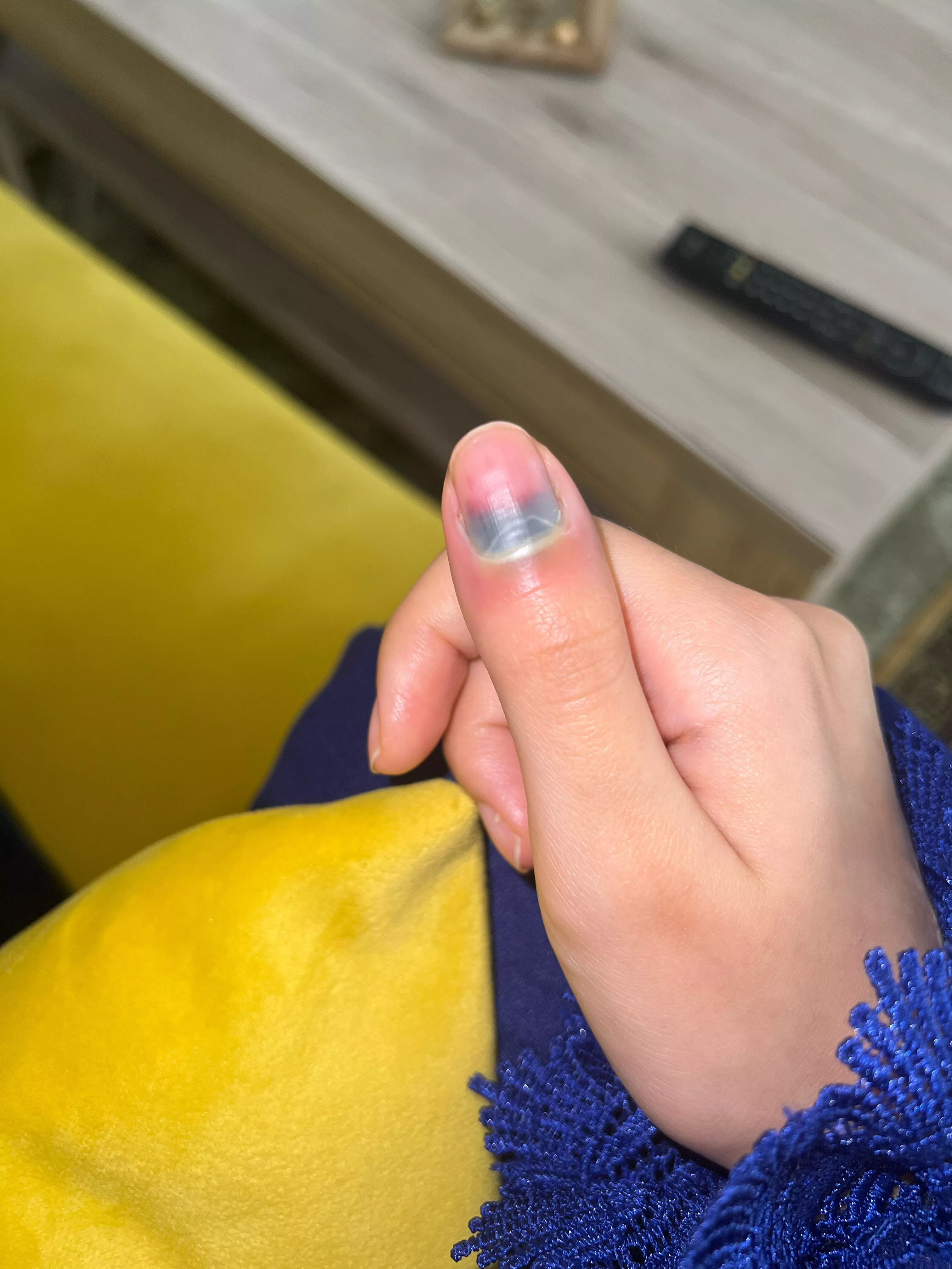 Subungual hematoma pus , should i let it heal by itself ? Or go to a doctor ?