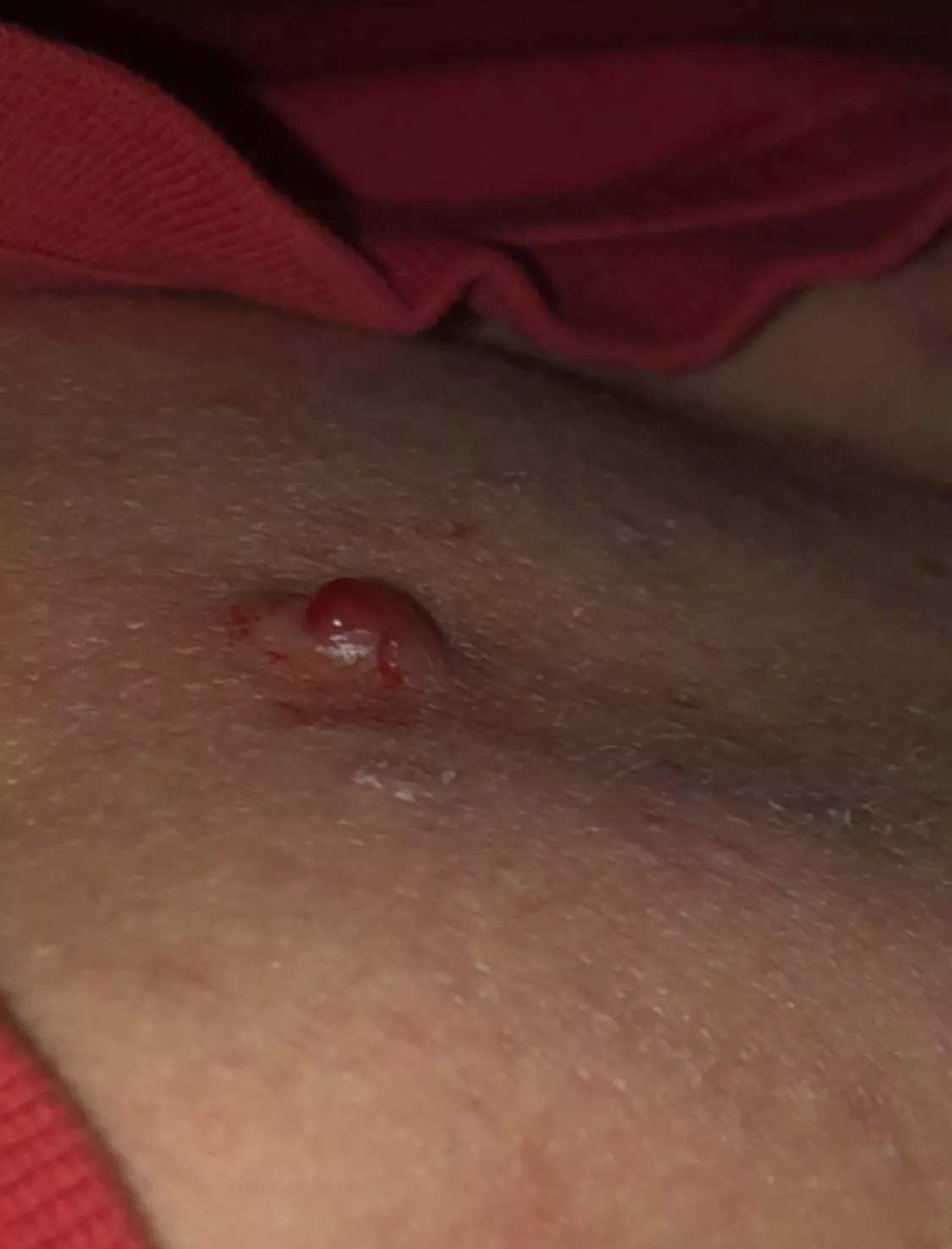 Its been weeks since I last picked it. Picked the crust and now its bleeding badly… Im thinking it may never go😬