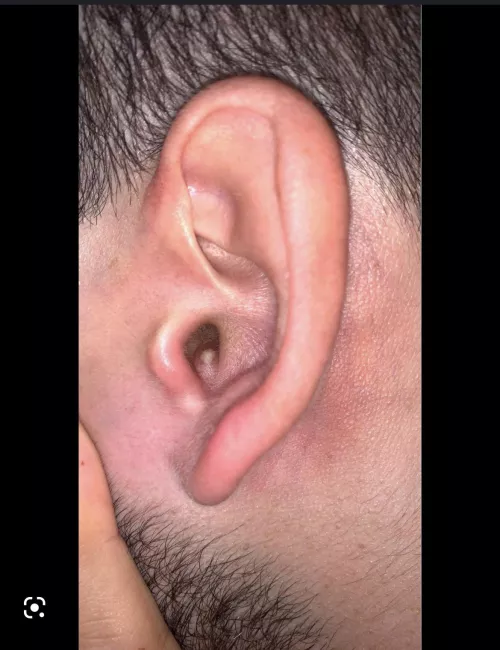 Ear pimple, no insurance, what to do?
