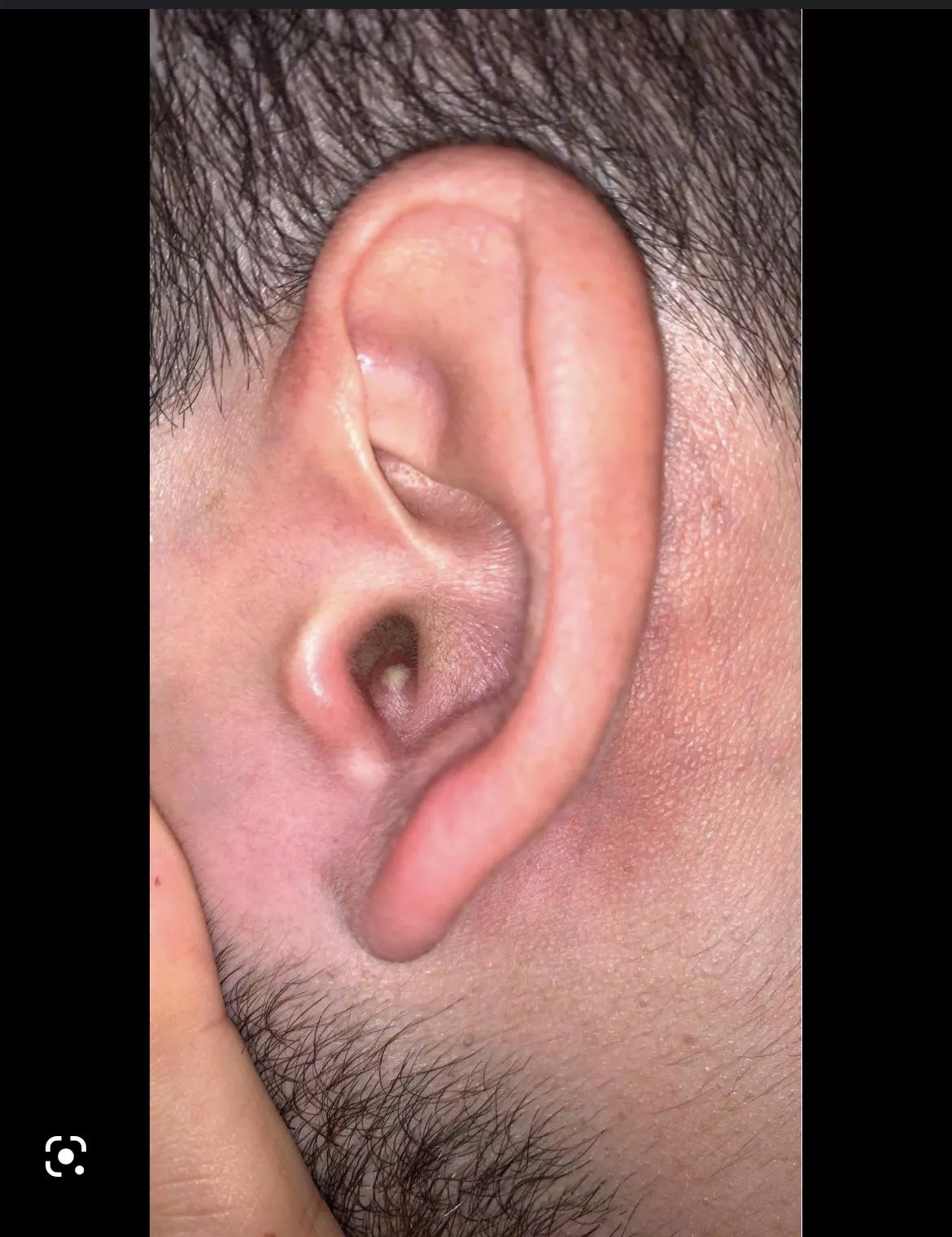 Ear pimple, no insurance, what to do?