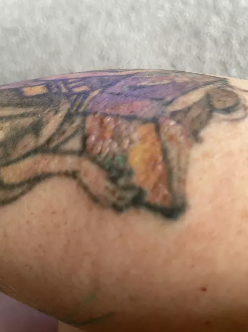 I’m getting a tattoo removed and had a treatment yesterday. Left some nice forbidden pops on the colored sections today.