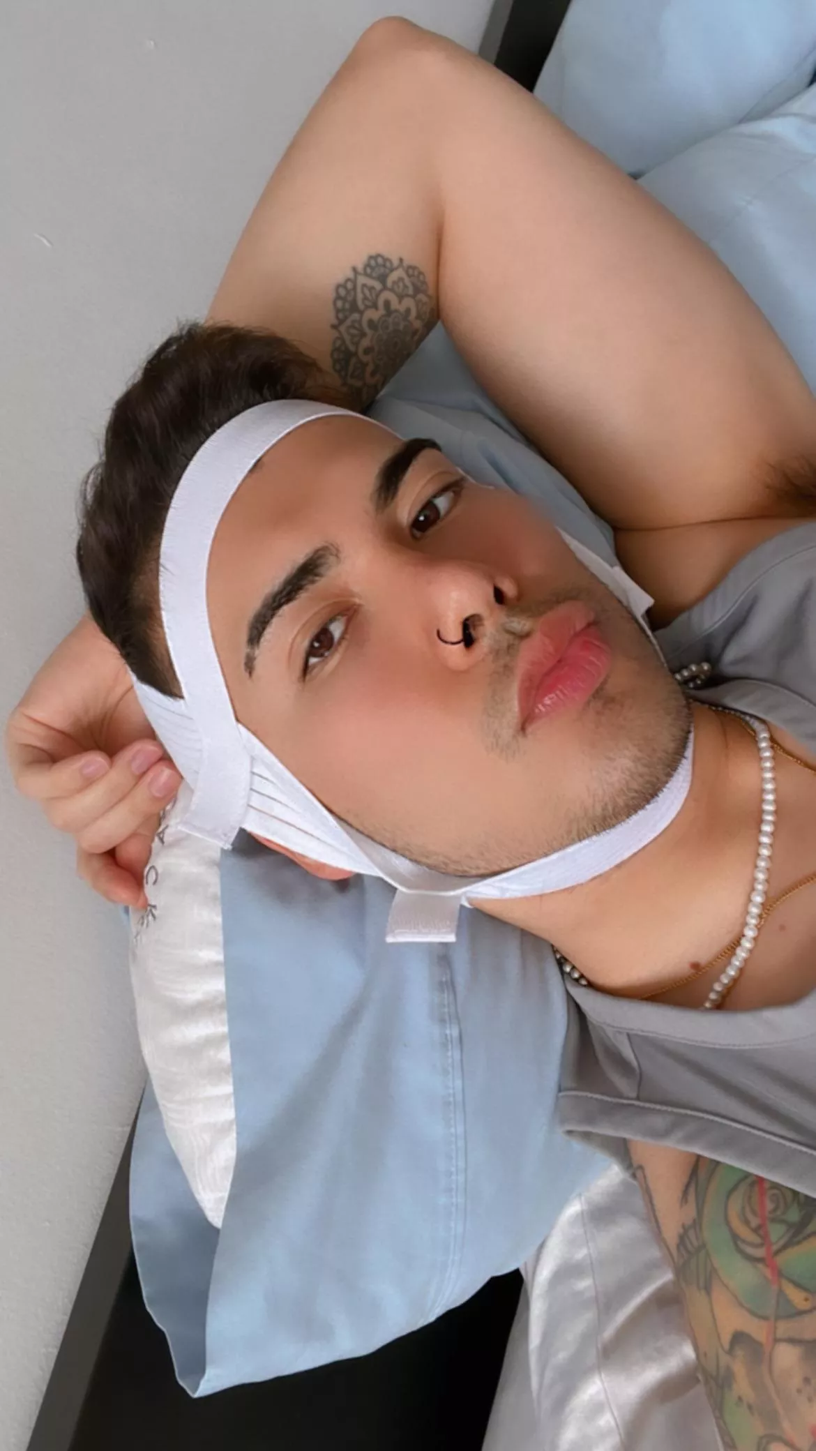 3 days post kybella 🥲