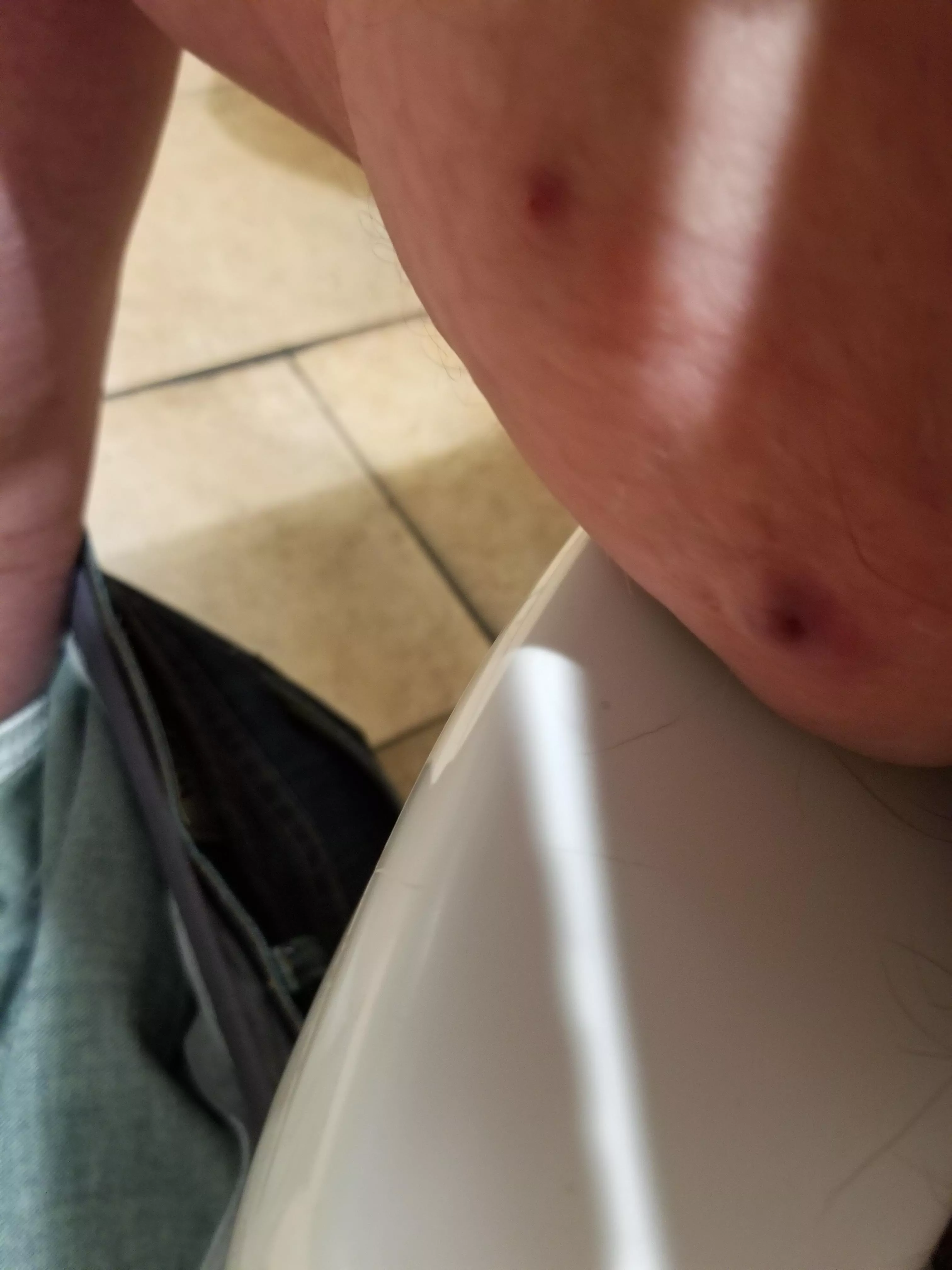 Anyone know what this is? It appears to be full of blood and it's really sore. (Possibly NSFW for inner thigh and slight pubes)