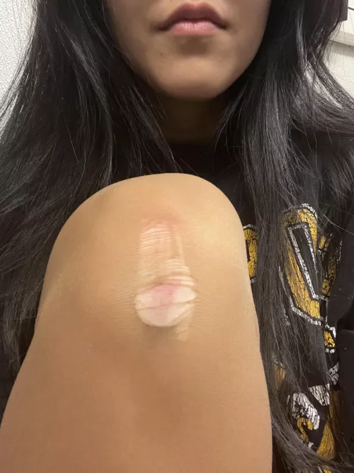 Fell at Hooters and ripped them 🥹😭